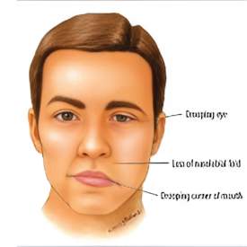 Setu Brain and Spine neurocare neurophysician Hospital Bells palsy Diseases Palanpur Banaskatha Gujarat India