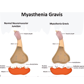 Setu Brain and Spine neurocare neurophysician Hospital Myasthenia Gravis Diseases Palanpur Banaskatha Gujarat India