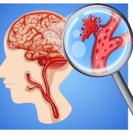 Setu Brain and Spine neurocare neurophysician Hospital Stroke Diseases Palanpur Banaskatha Gujarat India